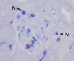 Neutrophils in the inflammed glomerulus